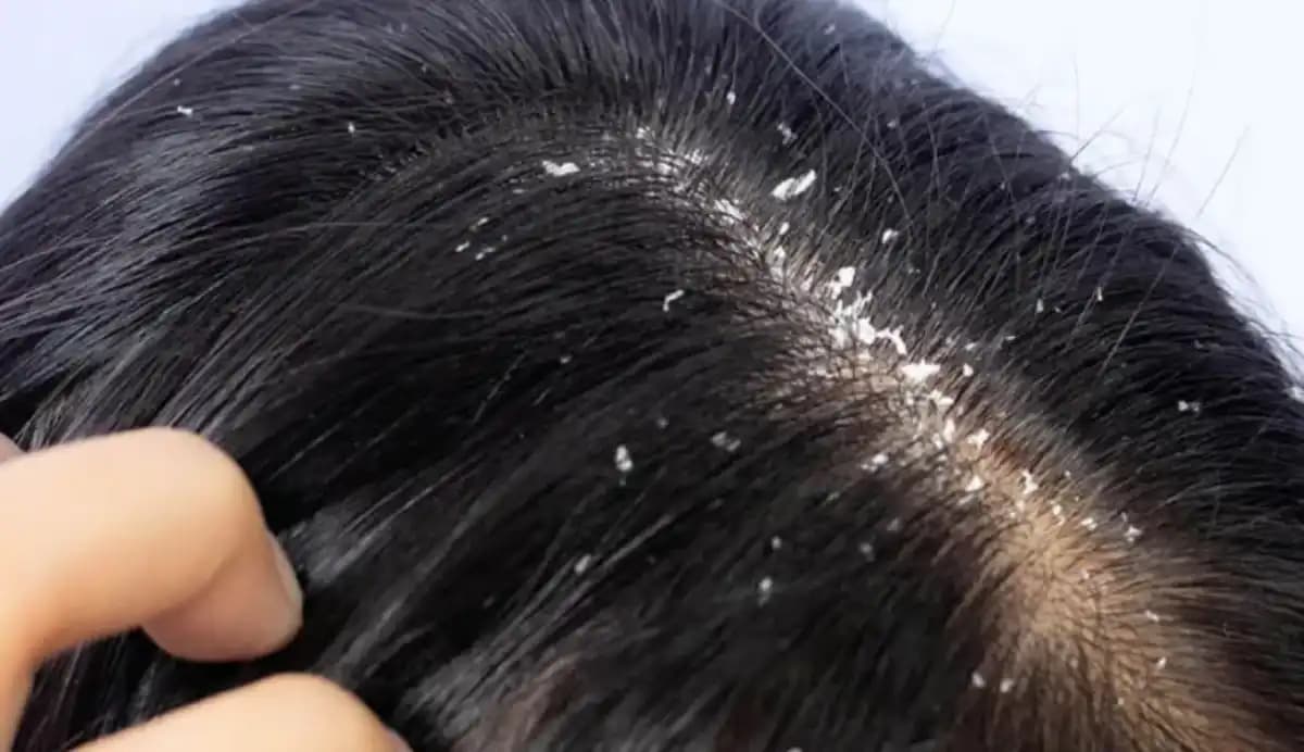 Hair Care: Say Goodbye to Dandruff with These 2 Ingredients