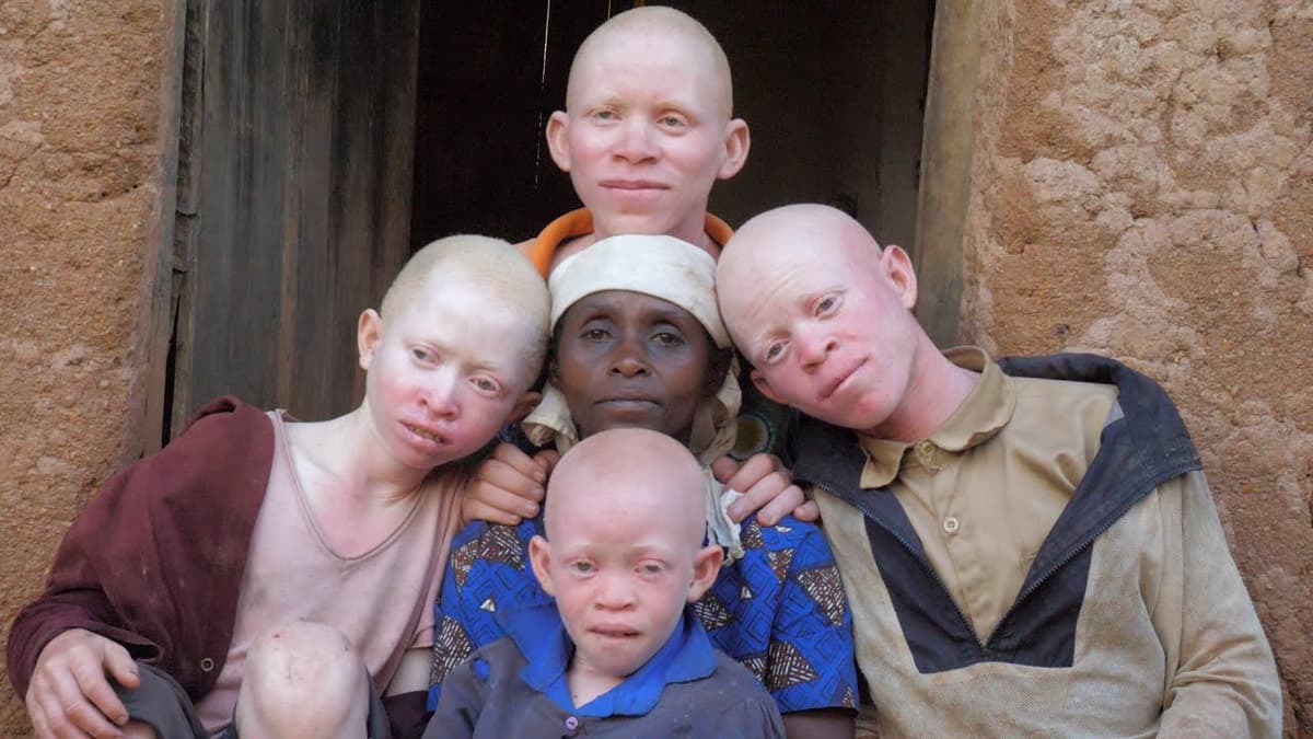 RDC: le corps d’un enfant albinos retrouvé sans tête ni jambes, en pleine visite du pape François