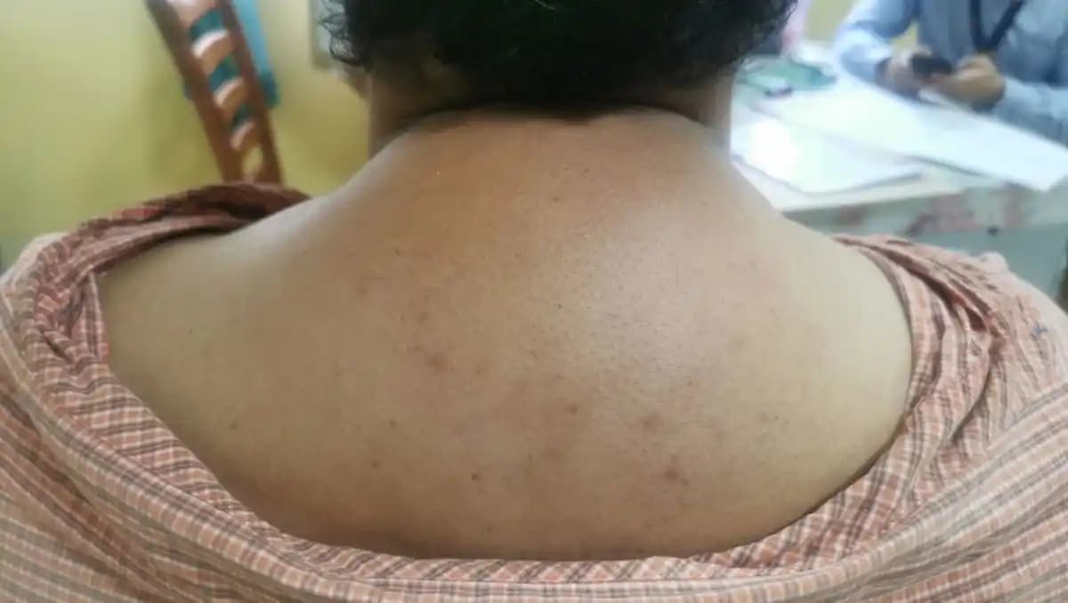 Bosse de bison sur le dos, souvent liée à des problèmes de santé ou de posture.