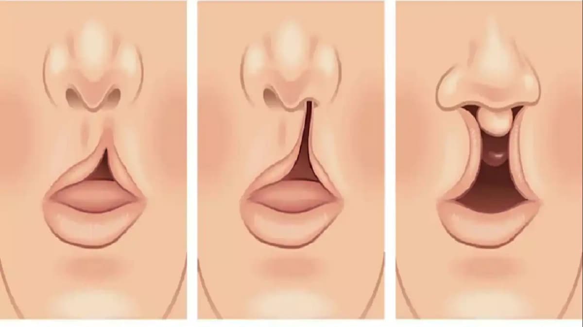 SantéÂ : tout ce qu’il faut savoir des fentes (bec de lièvre)