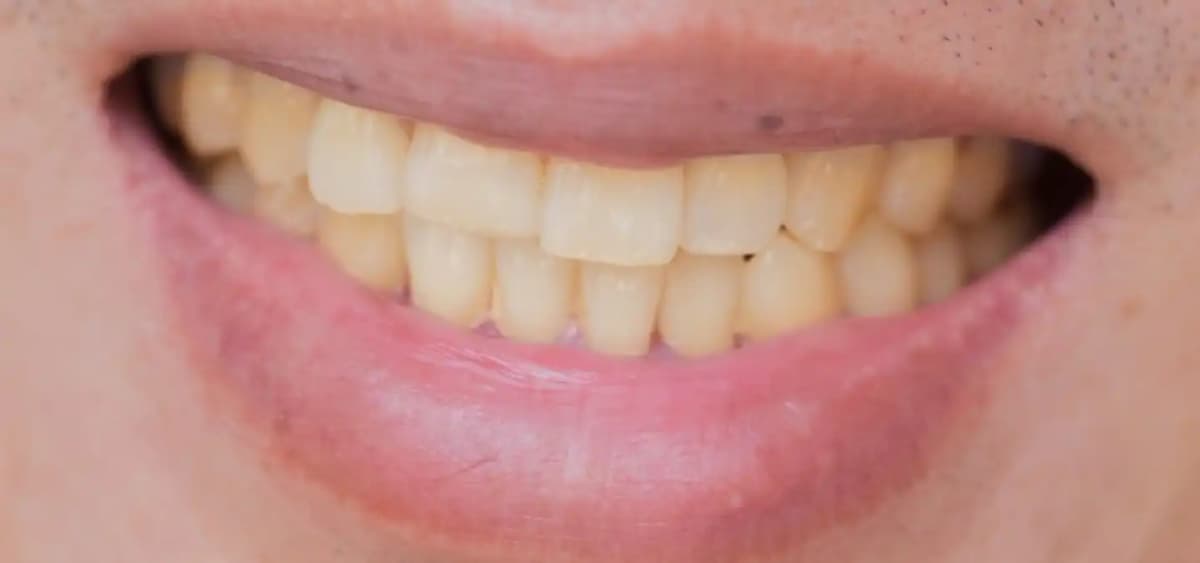Bon Ã  savoir : 02 raisons principales pour lesquelles les dents se jaunissent