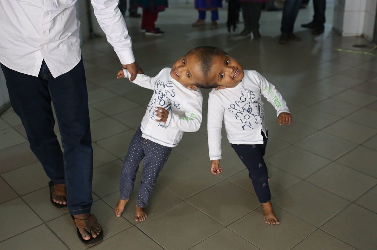Brésil : reliés par la tête, 2 frères siamois séparés