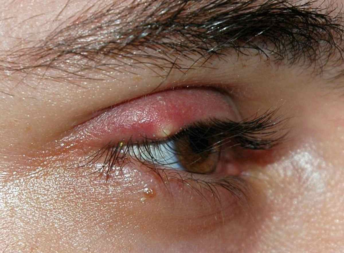 L’orgelet : 04 astuces naturelles pour soulager ce mal
