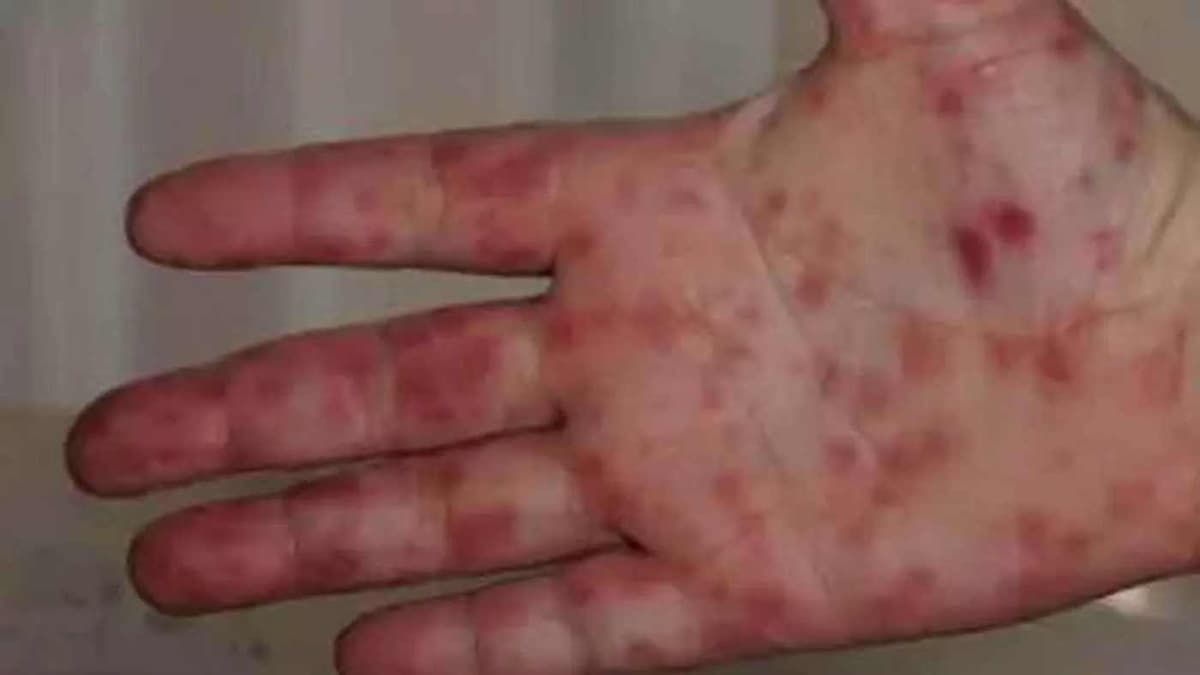 Grippe de la tomate: voici tout ce qu’il faut savoir sur ce nouveau virus qui attaque les enfants