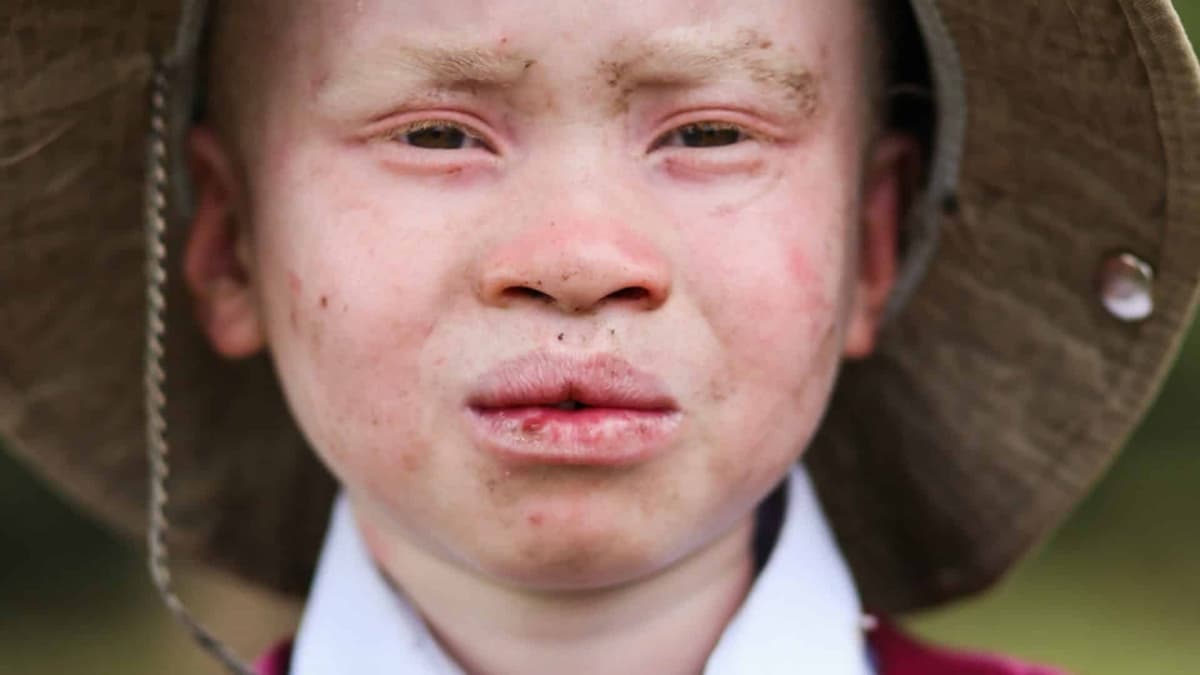 Pour sacrifice rituel, un père met en vente ses trois enfants albinos pour 25 millions f CFA