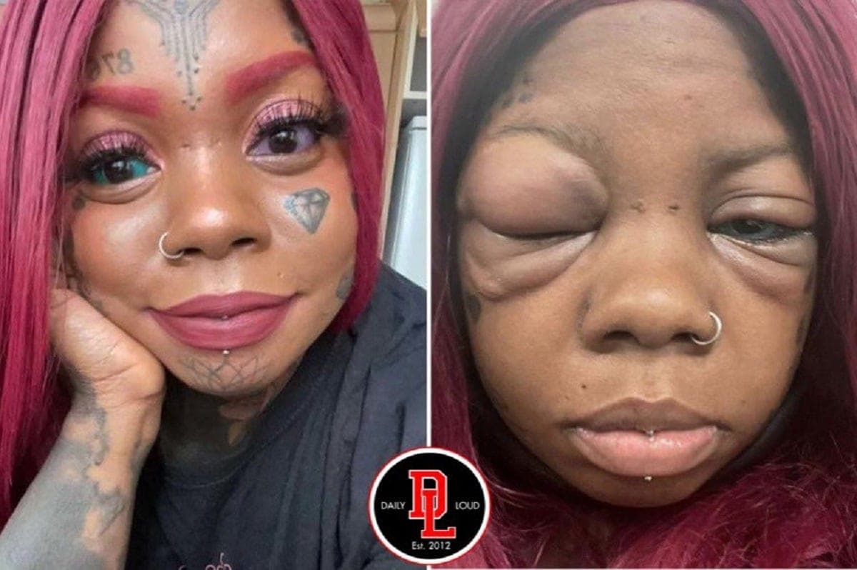 Island: elle perd la vue après s’être fait tatouer ses globes oculaires en imitant une influenceuse