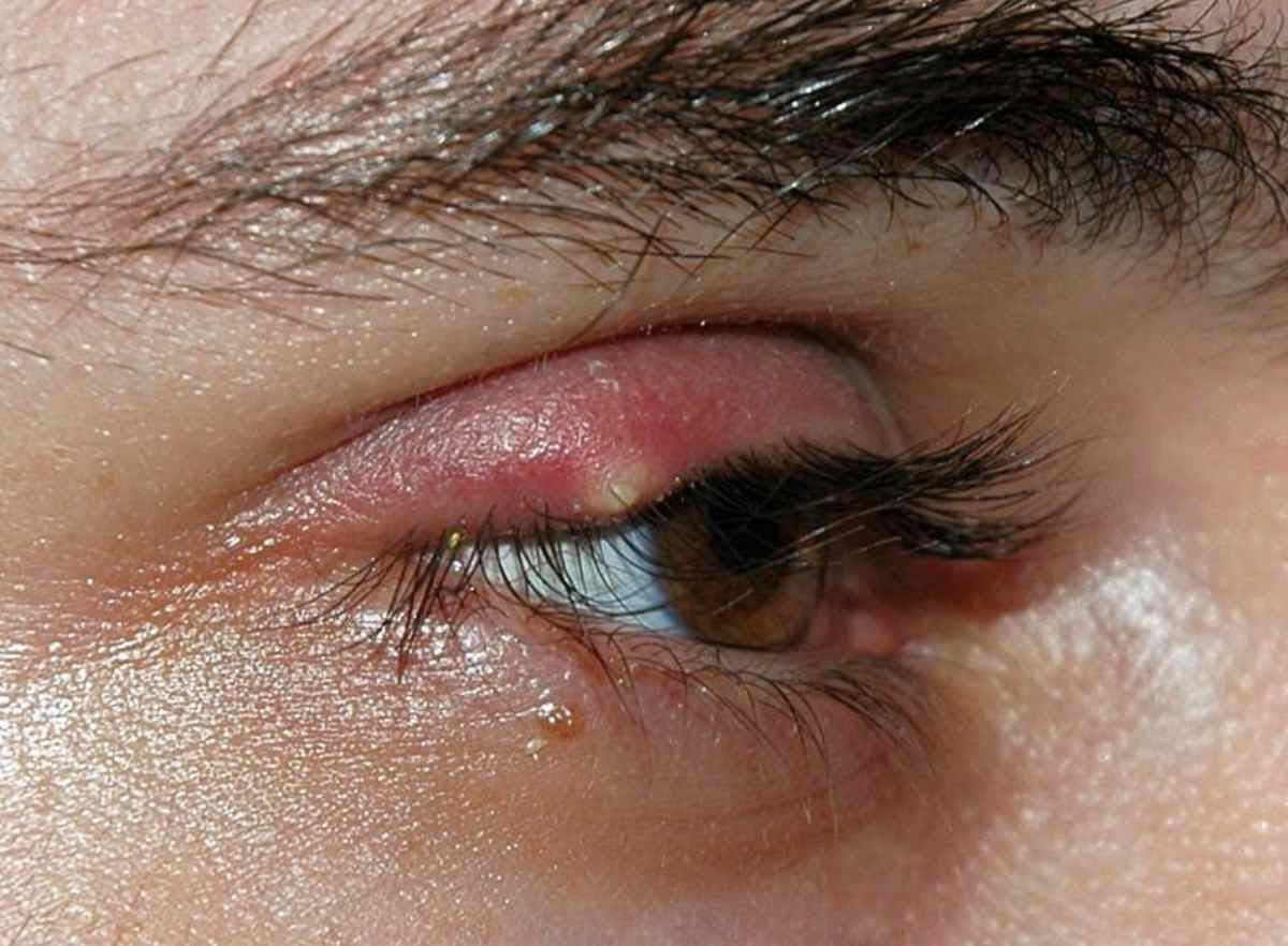L’orgelet : 04 astuces naturelles pour soulager ce mal