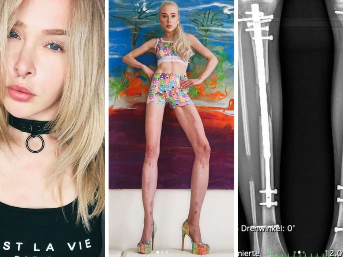 Une mannequin allemand dépense une fortune pour allonger ses jambes de 14 cm