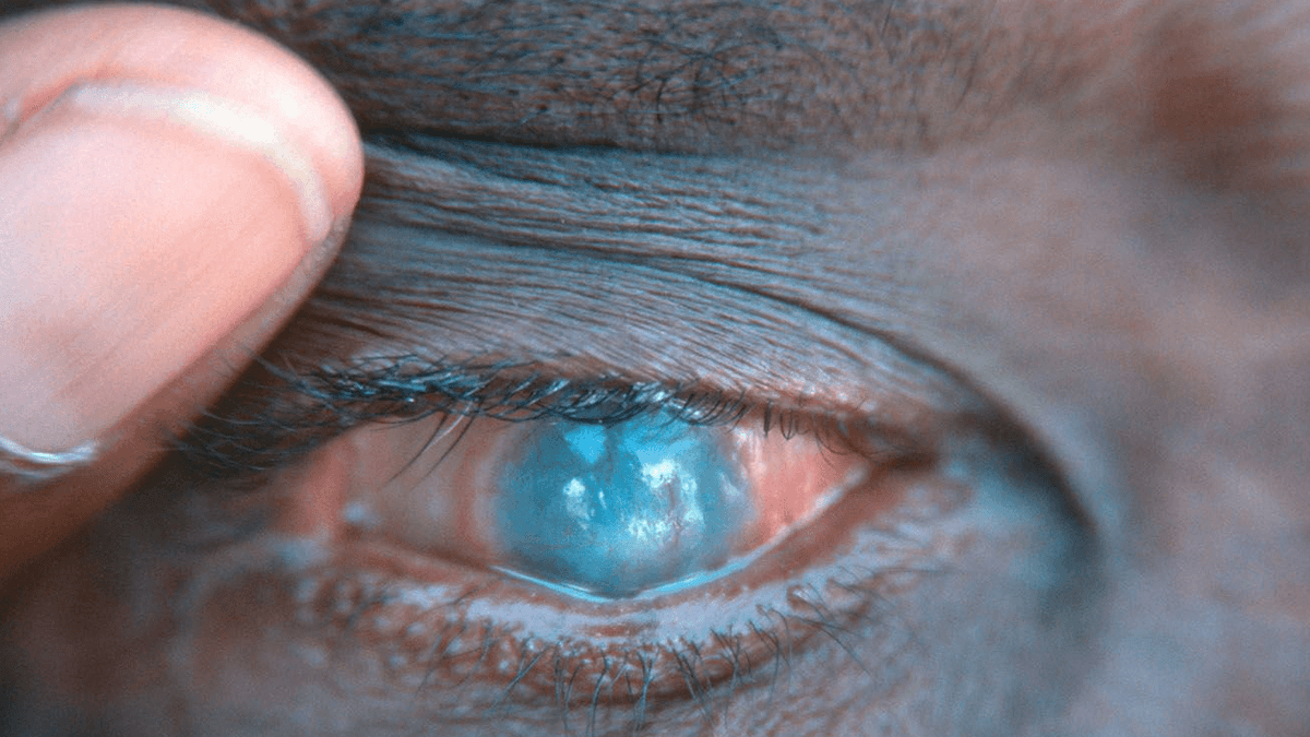 Le Bénin et le Mali éliminent le trachome, une victoire majeure contre la cécité