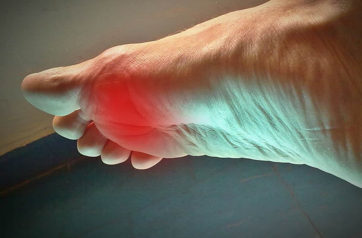Métatarsalgie: tout ce qu’il faut savoir sur cette pathologie courante, mais négligée