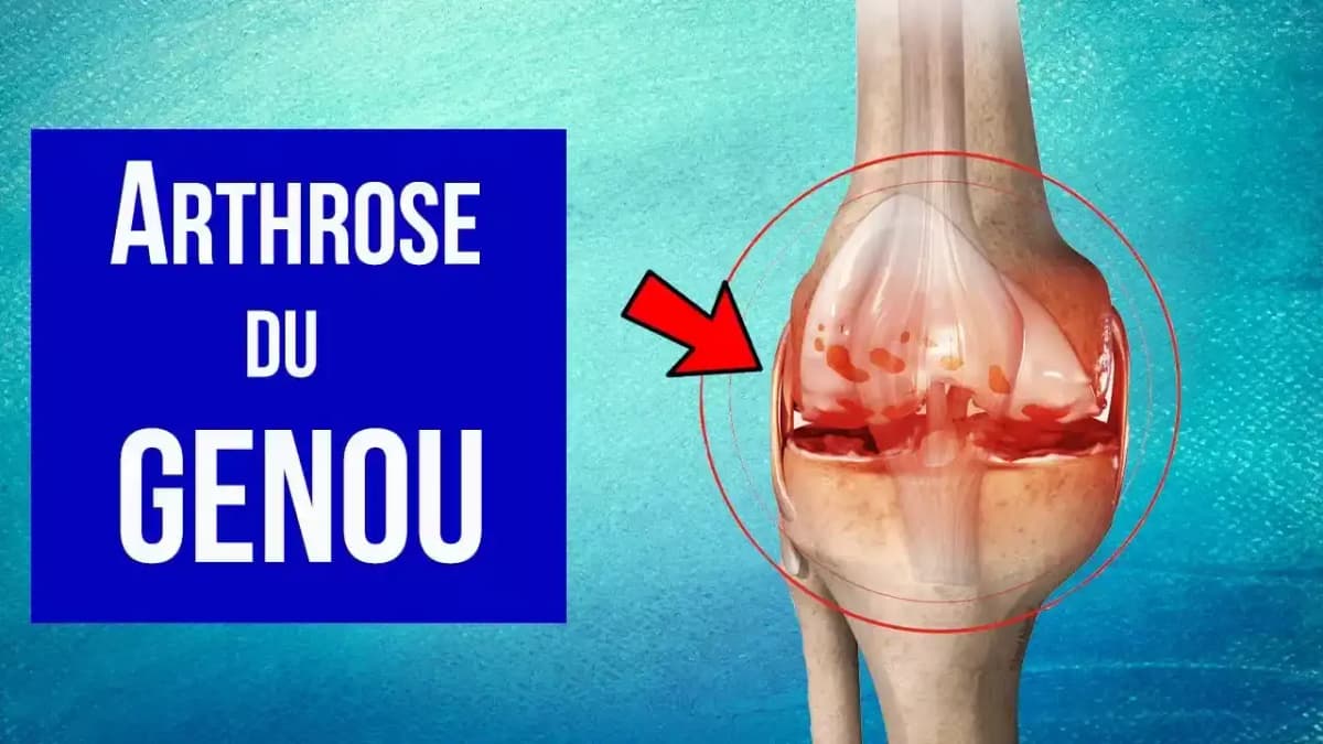 Soulager l’arthrose du genou: des gestes simples pour améliorer son quotidien