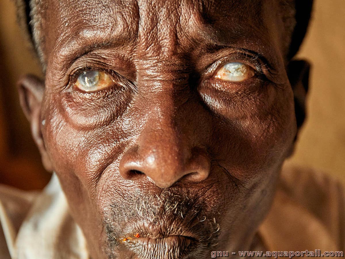 Lutte contre l’onchocercose : le Bénin lance une campagne de vaccination nationale