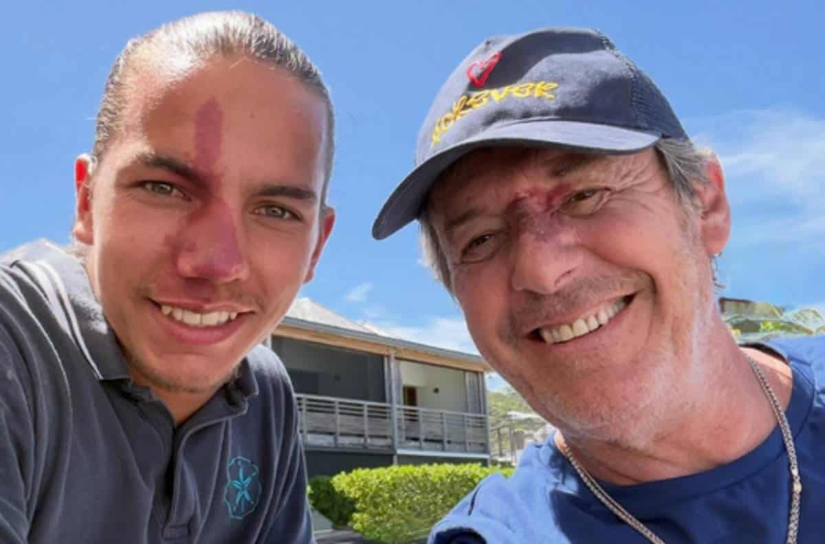 Jean-Luc Reichmann retrouve Gabin, tous deux marqués par un angiome au visage