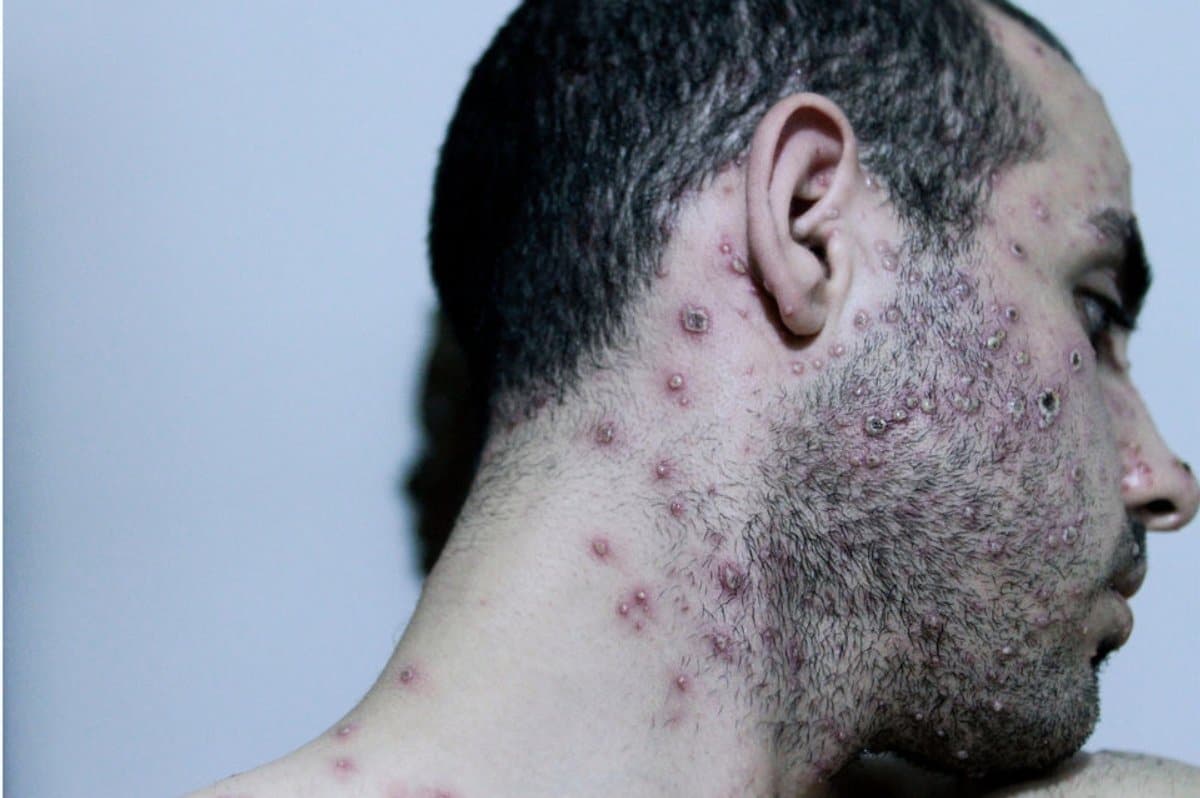 Kenya : sept cas de Mpox confirmés