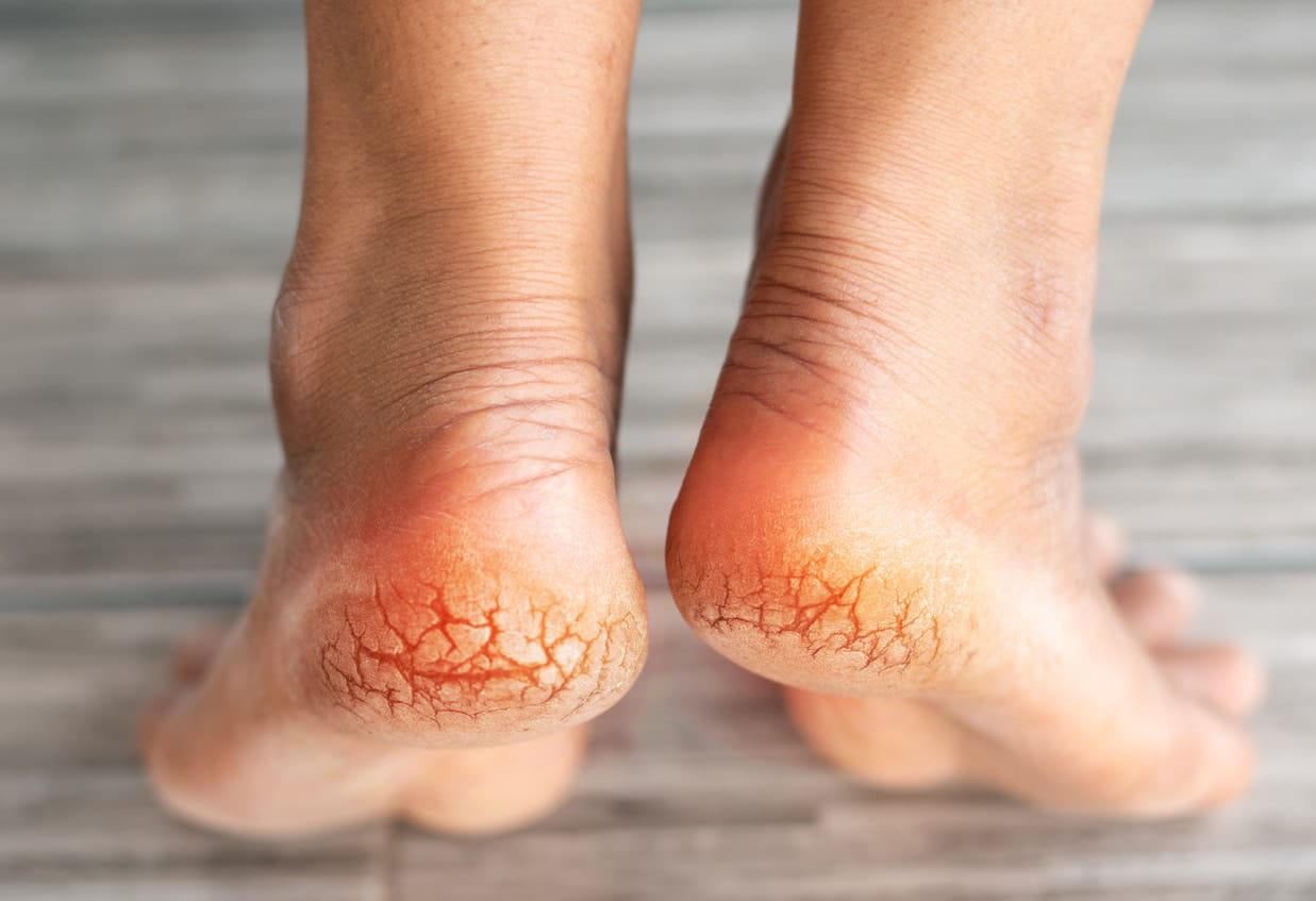 08 remèdes naturels contre les crevasses des pieds