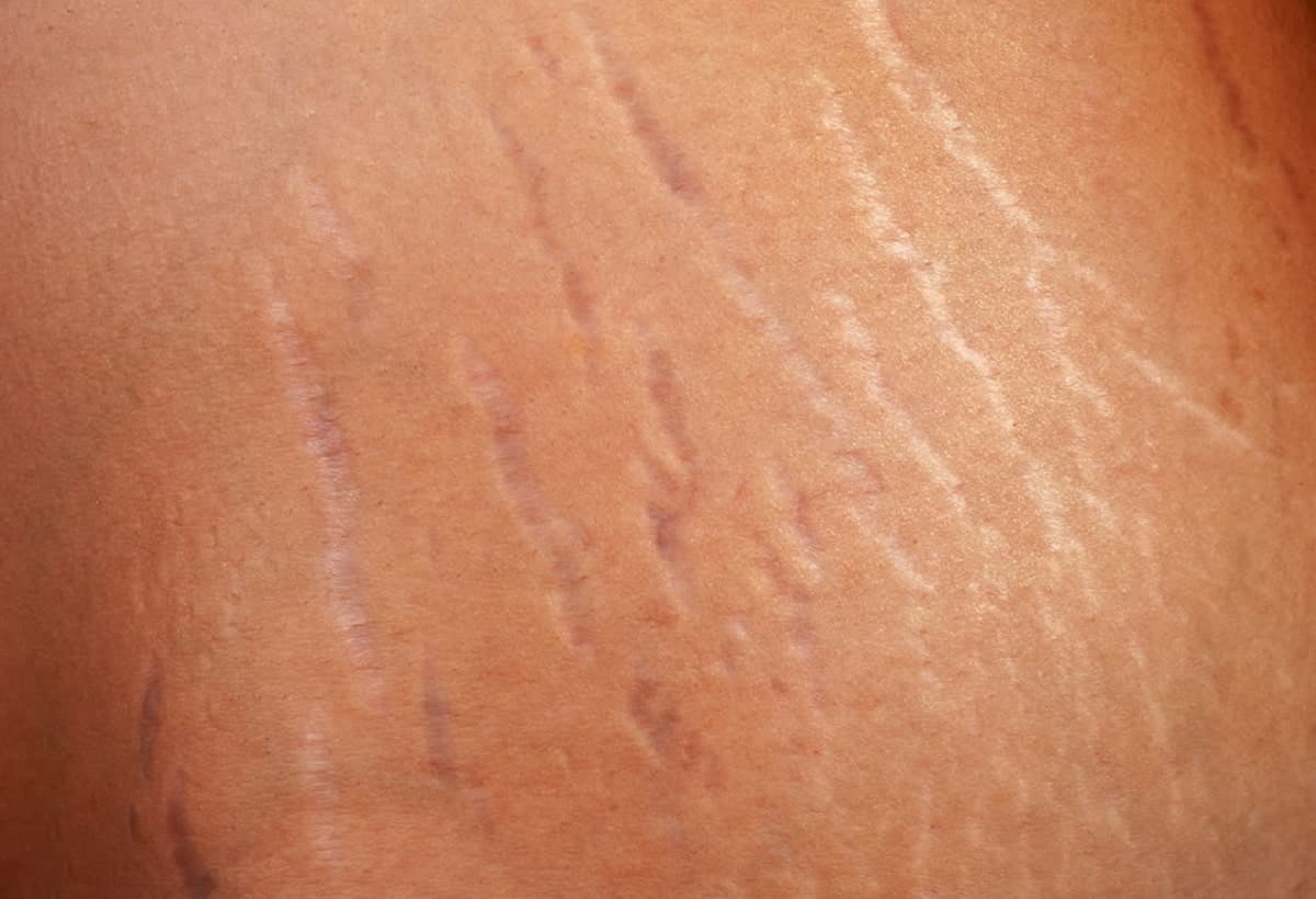 Vergetures: recette naturelle pour les réduire