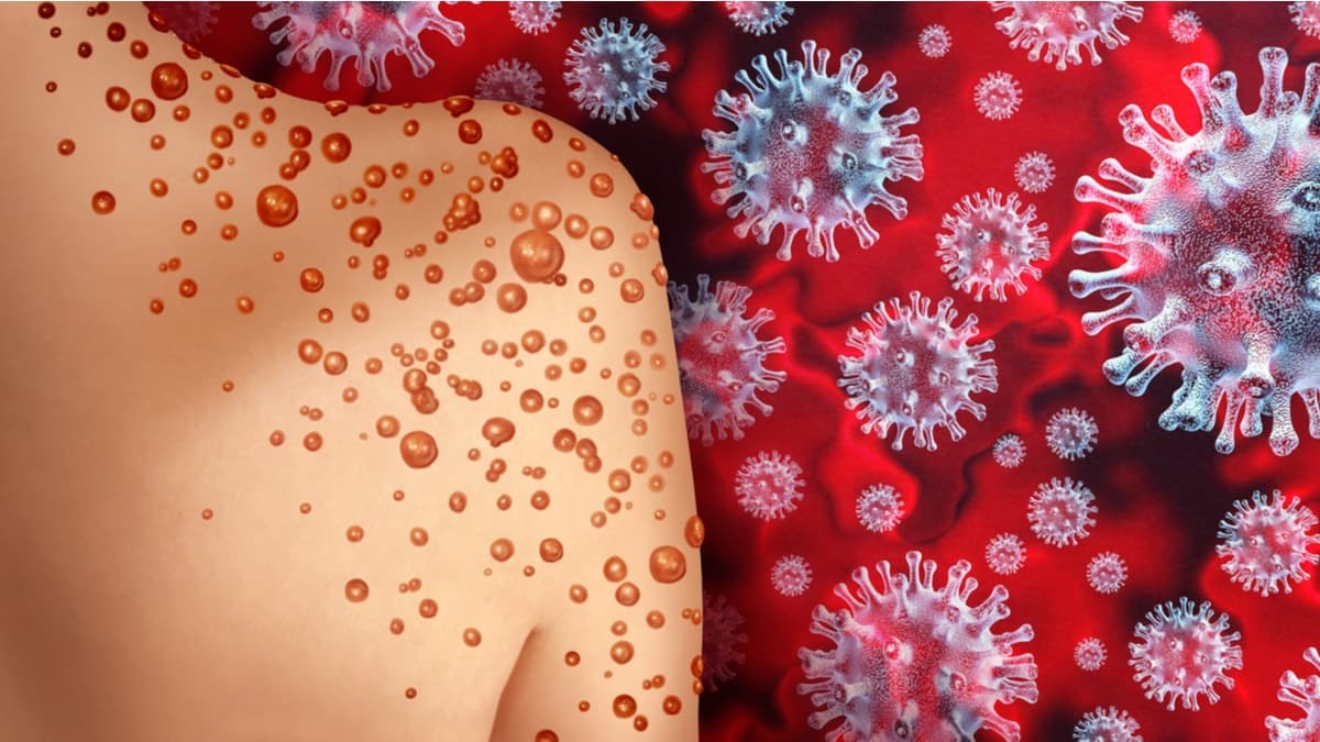 Zambia records its first mpox-related death and 31 confirmed cases