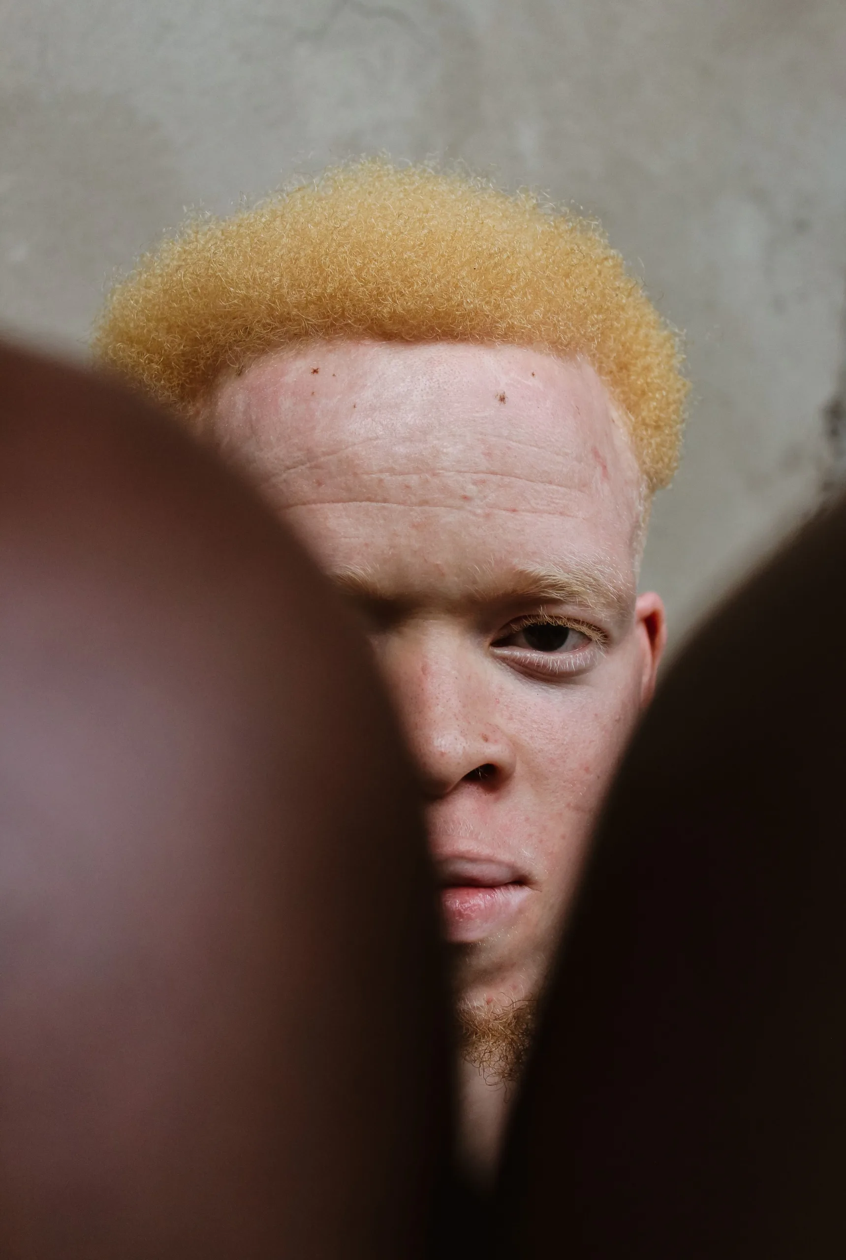 Albinism: Skin changes that warrant medical advice