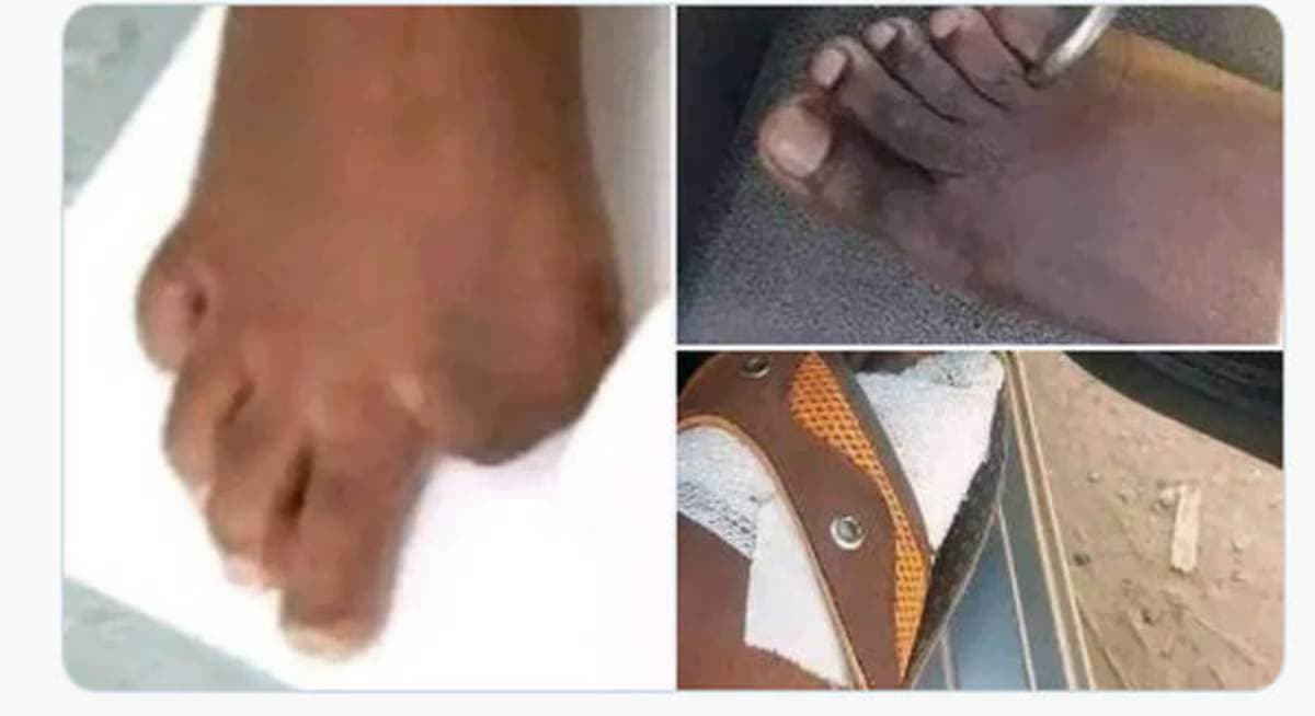 Zimbabwe: montrer ses pieds pour démentir les rumeurs de trafic d’orteils