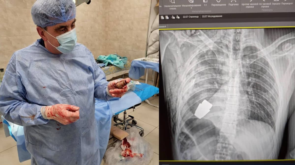 Guerre d’Ukraine: un chirurgien retire une grenade non explosée du corps d’un soldat ukrainien