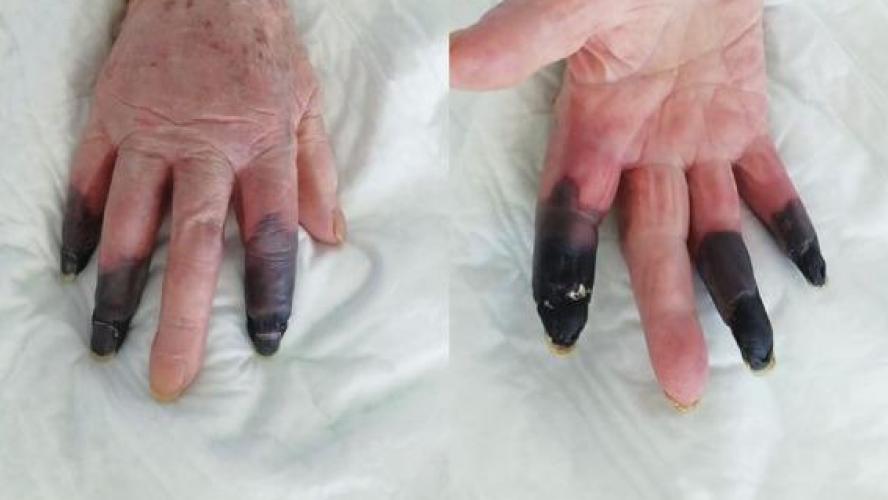 Résultat de recherche d'images pour "Covid-19: une Italienne de 86 ans amputée de trois doigts"